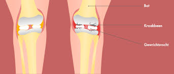 Foto bij het artikel: "Interessante informatieavond gewrichtsklachten en artrose"